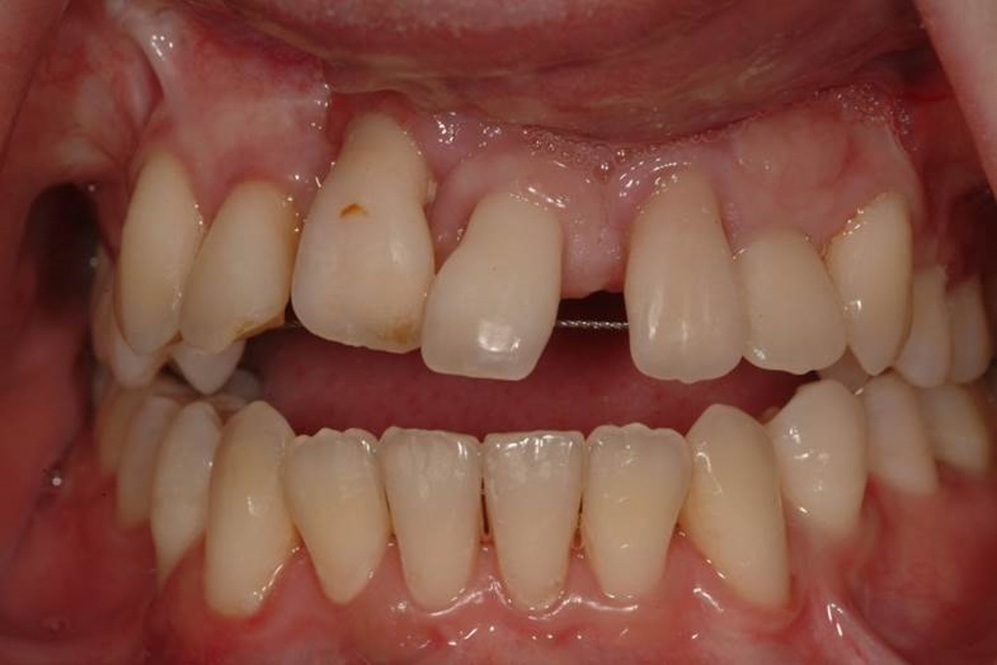 Implants multiple teeth Galway