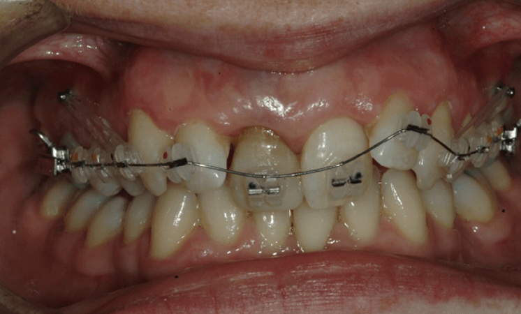 Orthodontics and Single Implant Case 12