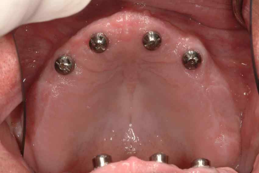 arch teeth implants