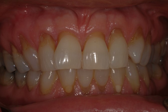Bleaching or tooth whitening Galway