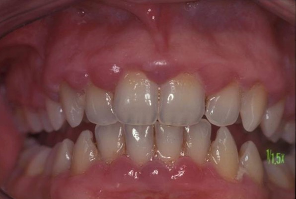teeth whitening Galway
