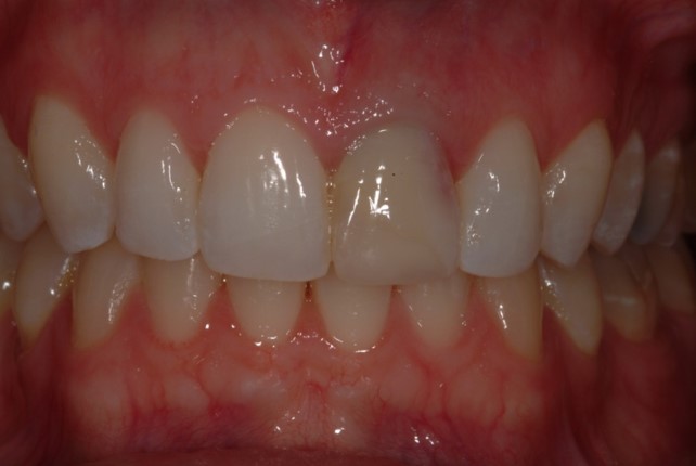 teeth implants before and after
