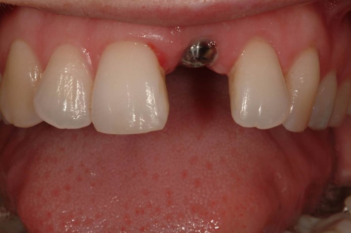 teeth implants Ireland