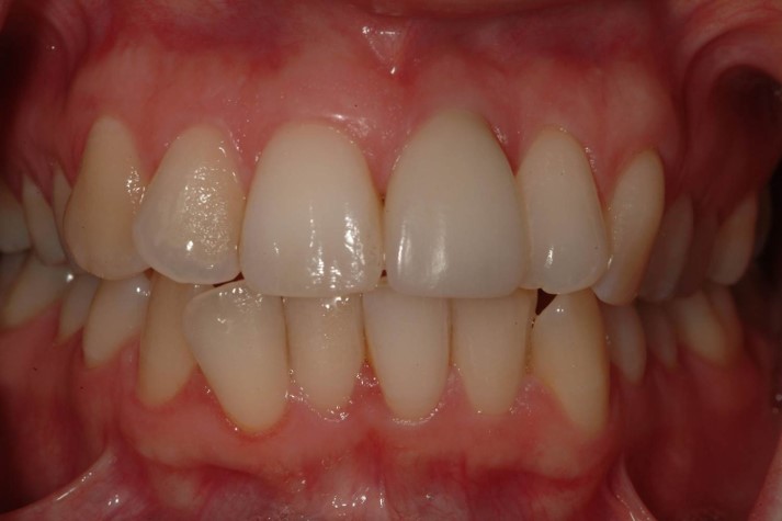 teeth implants Galway