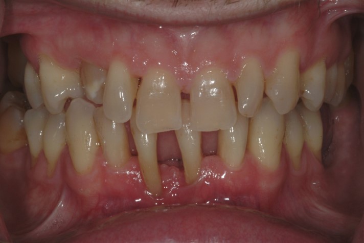 teeth restoration and replacement
