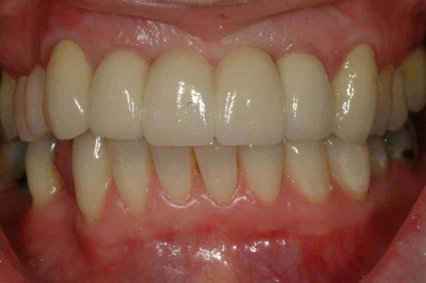 front tooth replacement Galway