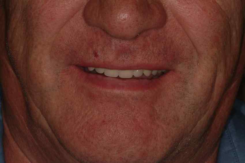 Full Arch Teeth Implant Galway