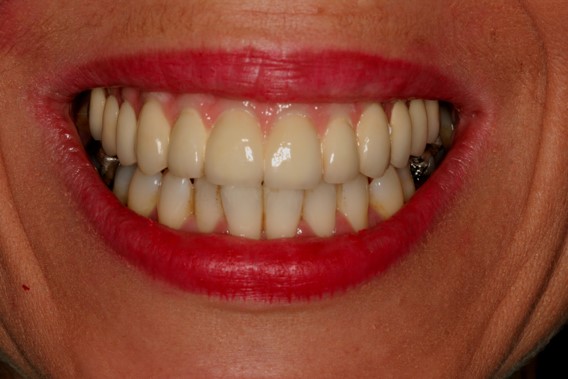 front teeth implants before and after