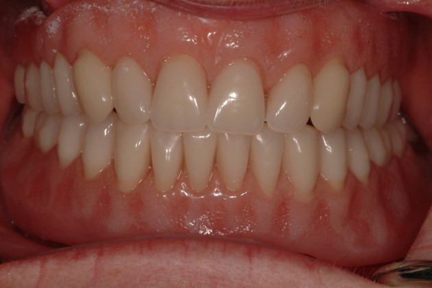 Implants Lower teeth before and after