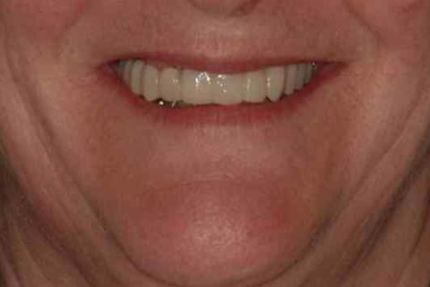 Implants multiple teeth before and after